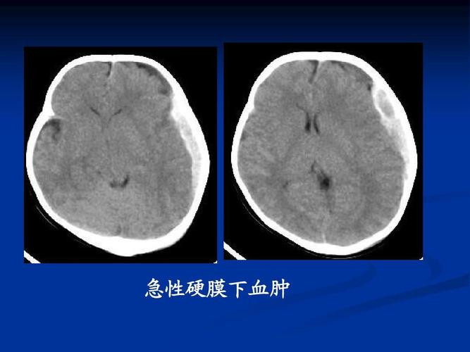急性硬膜下血肿