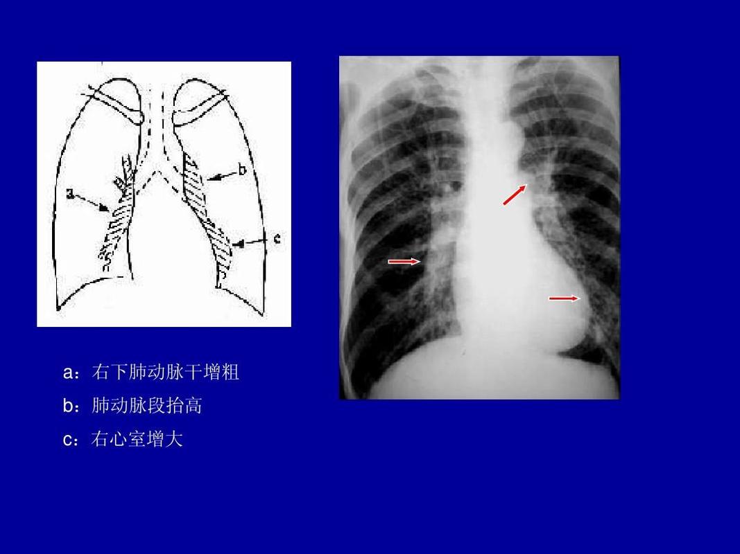 右下肺动脉干增粗 b:肺动脉段抬高 c:右心室增大