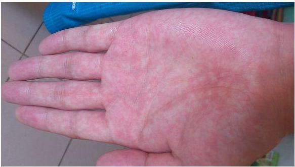 或是有红色斑点,斑块,按压后变成苍白色后又呈红色,那就是得了肝掌