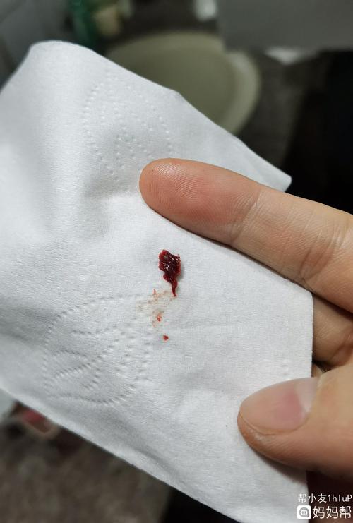 是内膜息肉脱落吗?