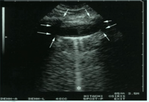 少量胸腔积液可以看到四边形征和正弦征,四边形征指胸腔积液时将胸膜