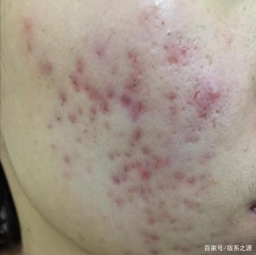红色痘印-暂时性红印: 成因:炎症性痤疮消退后的早期表现,此时炎症还