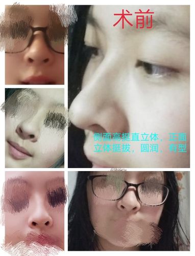 鼻中隔偏曲手术后鼻子塌了,如图,怎么办想找医院理赔