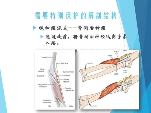 桡骨头颈骨折手术入路