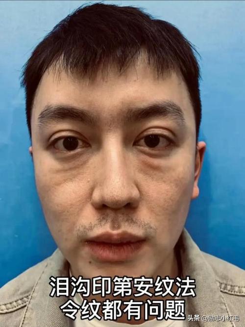 可是做完整容手术之后,他脸上的泪沟,法令纹,印第安纹不仅全都加深了