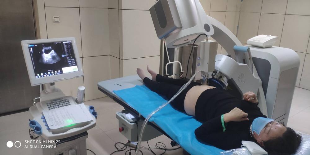 体外冲击波碎石