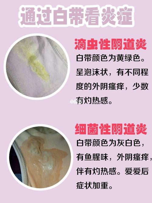 对比白带颜色 了解自己是哪种炎症?_炎症_凝胶_妇科