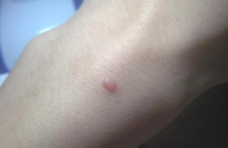 【皮肤肉瘊子图片大全】_是什么_症状表现_苹果绿