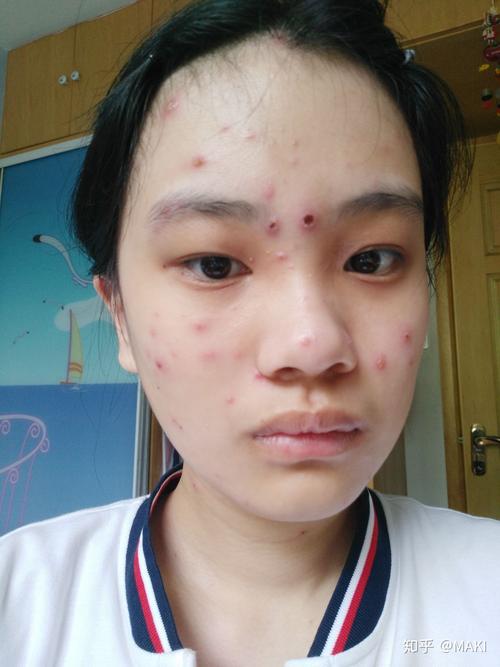 与水痘抗战的6天持续更新