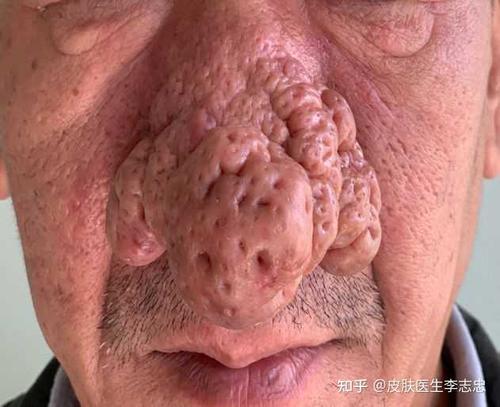 皮肤医生李志忠 的想法: #酒渣鼻# #酒糟鼻# 中药治疗