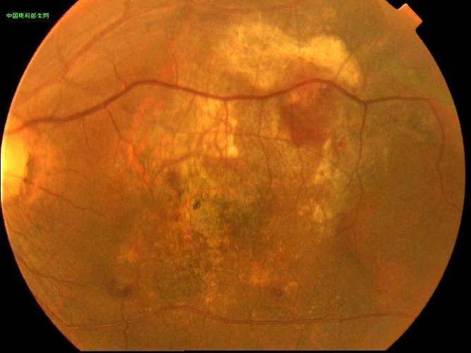 年龄相关性黄斑变性