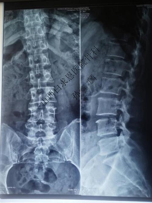 我院腰椎正侧位及动力位x片显示,患者腰椎呈姿势性侧弯,退变明显,l4/5