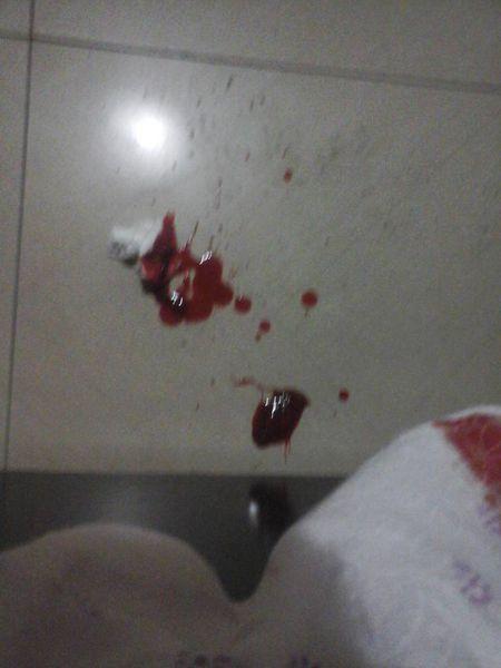 鼻子流血不止 还用流血块 怎么办 我家没有止血之类的药 离医院也远