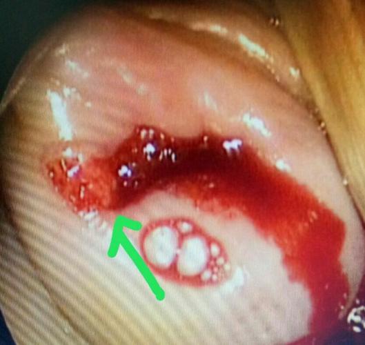 宫颈9点处有一绿豆大病灶,淡粉红色,细颗粒状,质脆,触之易出血,钳取时