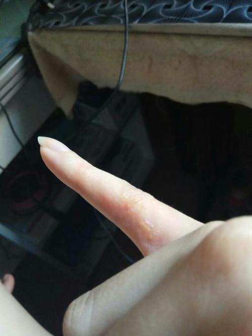 手指起了一些小泡泡,是皮藓嘛?好像之前贴过创口贴是粘的那个过敏嘛