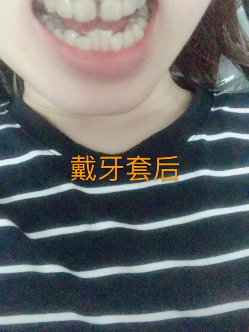 隐形牙套_牙套_时代天使_拔牙_补牙_广州自由行热门攻略_止痛药_时代