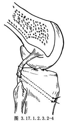 后交叉韧带股骨部撕脱的修补