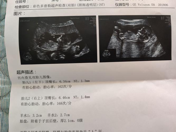 [试管婴儿]听说nt值可以看男女!