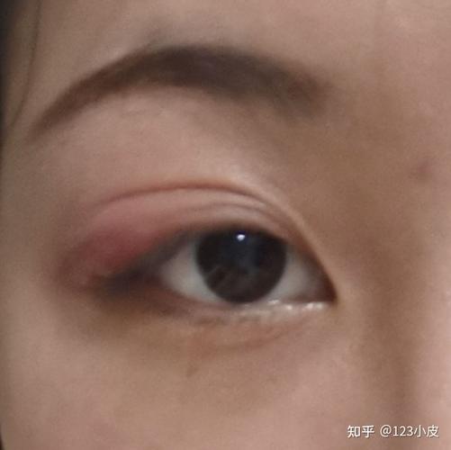记录眼睛麦粒肿的发展过程