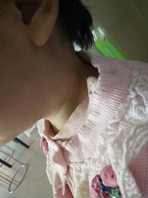 三岁小孩脖子上有个包,请大家看看这是什么?里面硬硬的,一碰还疼!