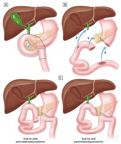 1. 传统胰十二指肠切除术(hofmeister 式胃空肠吻合术)