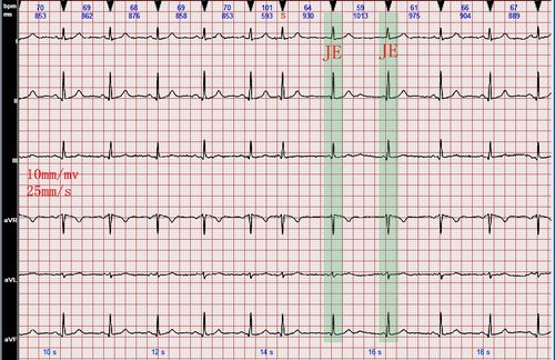 心电图知识交界性逸搏及交界逸搏心律