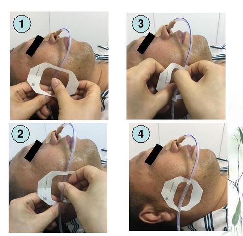 湘雅创新——胃管固定改良小窍门