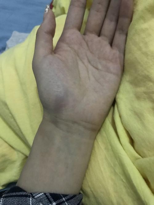 手掌人鱼线突然青了疼 也没碰 突然之间就青了 一按就