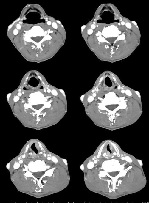 ct11659男性57岁反复声嘶1年加重半年