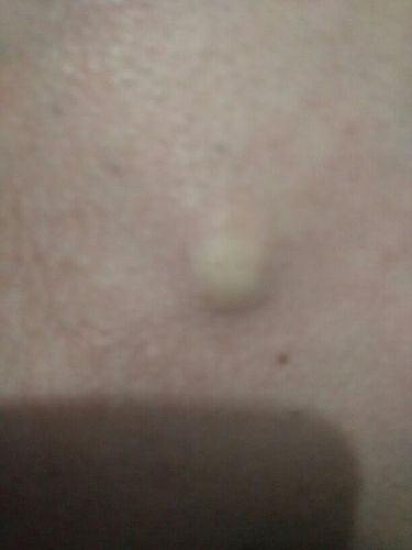 我腮帮下面长了个很玉米粒大的疙瘩,像是粉刺但是