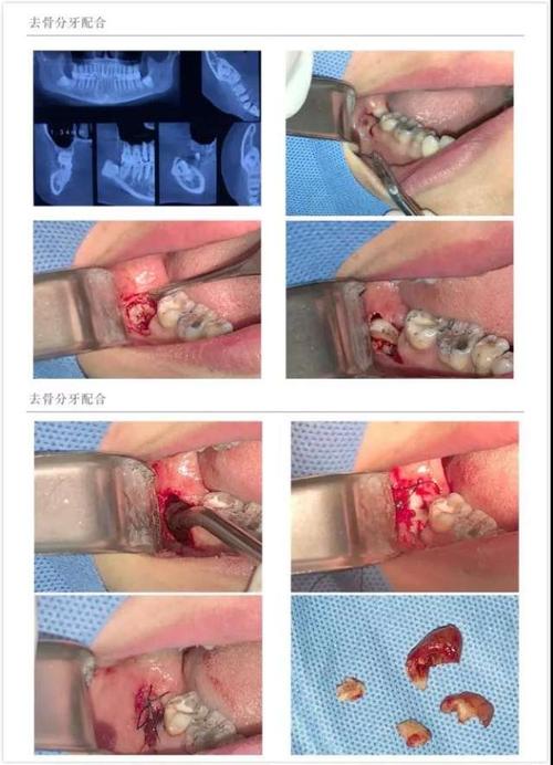 安全高效无痛微创拔牙