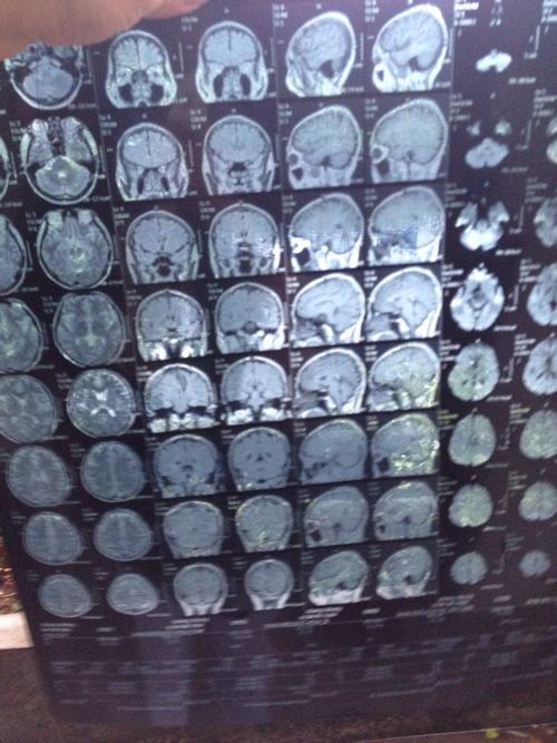 其他无明显症状,这是去检查脑部的影像,医生诊断脑萎缩.请懂的帮忙