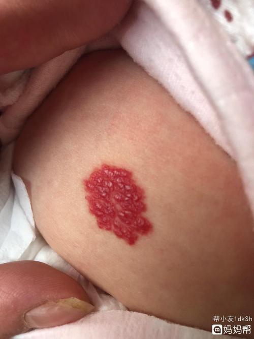 宝宝血管瘤怎么办