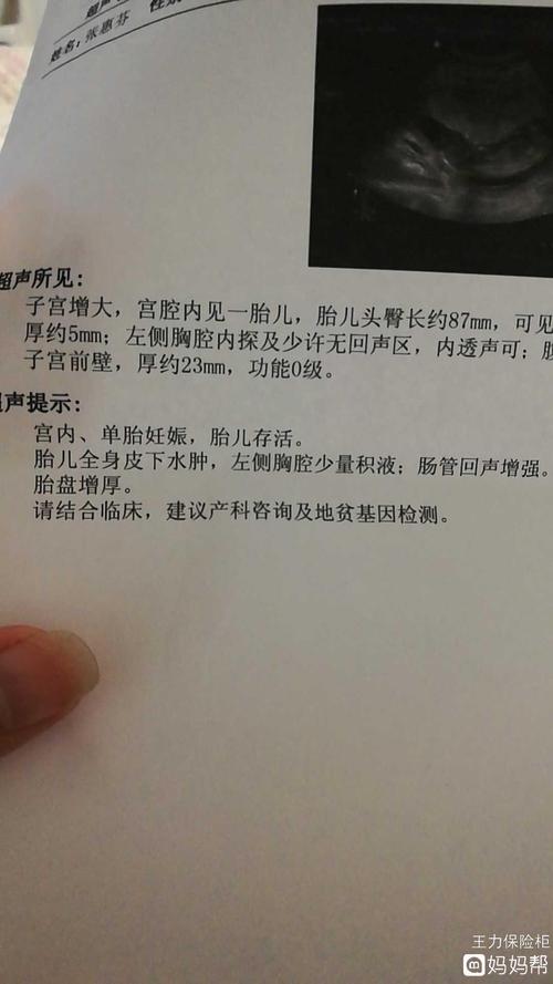 孕14 周胎儿全身皮下水肿,胸腔积液,地贫