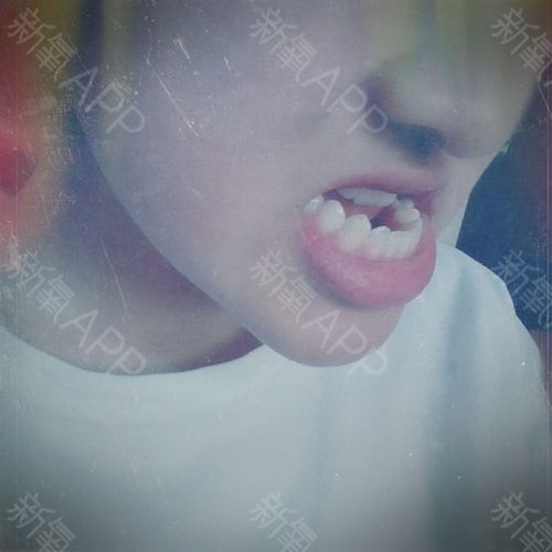 初二发现的地包天 也是那时候觉得自己好丑 我妈也是