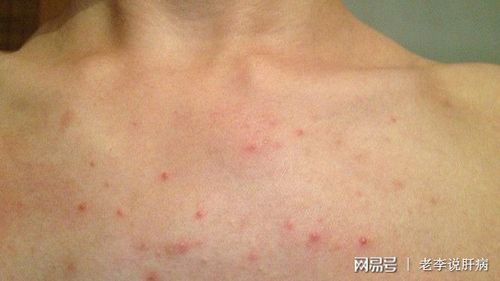 喝酒的人,身上长出"小红点",当心肝硬化