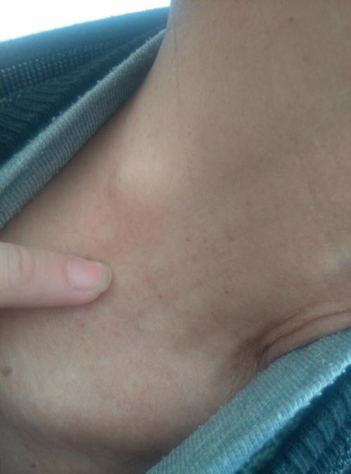 用手摸了摸是在皮肤里面,不是皮服囊肿什么的.