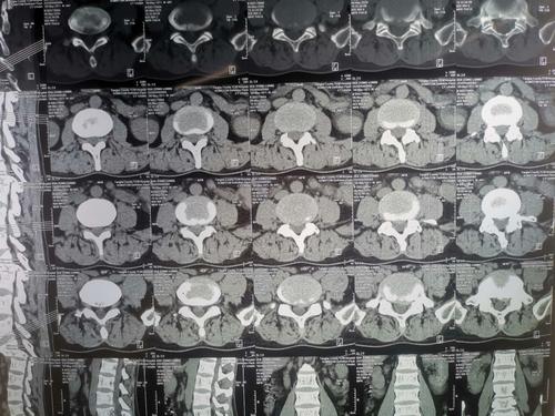 ct显示腰5骶1左侧椎间盘突出,神经根受压.