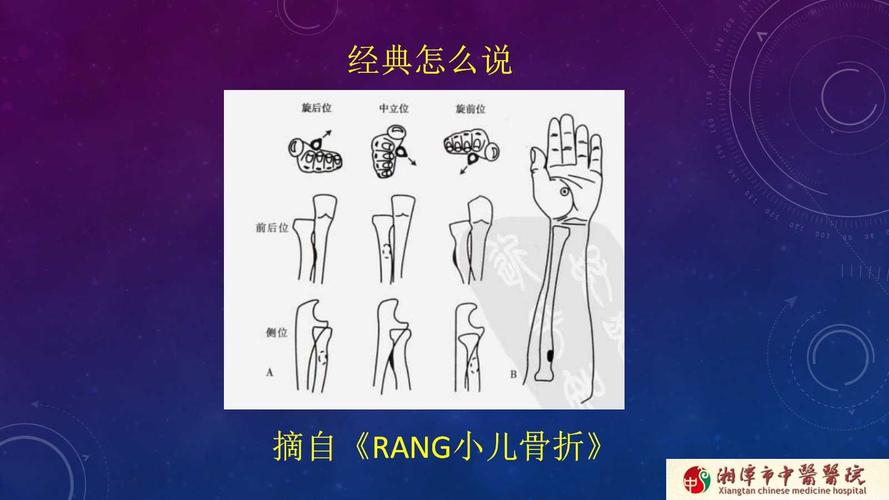 关于固定在什么位置,rang小儿骨折也没有给出定论积水潭实用骨科学