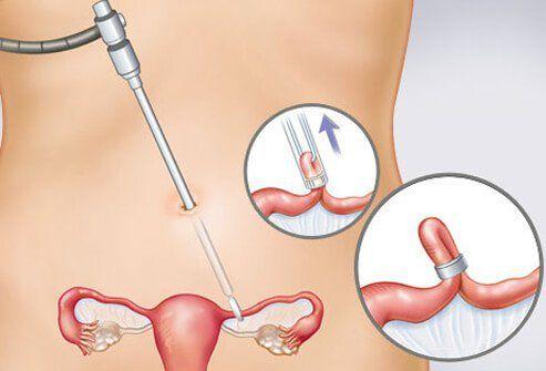 外国人常用的16种避孕措施看完直呼老外会玩