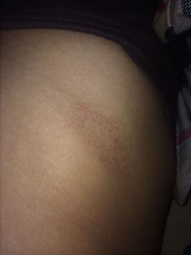 的部分也有不过没有右边大,想知道是平时穿牛仔裤磨的吗,还是皮肤真菌