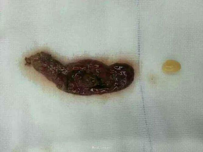 女性急性阑尾炎