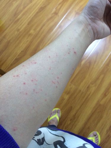 我这个是湿疹么?特别痒痒的小红点点