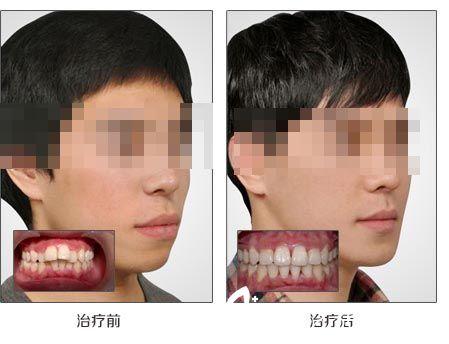 暴牙矫正手术前后对比图