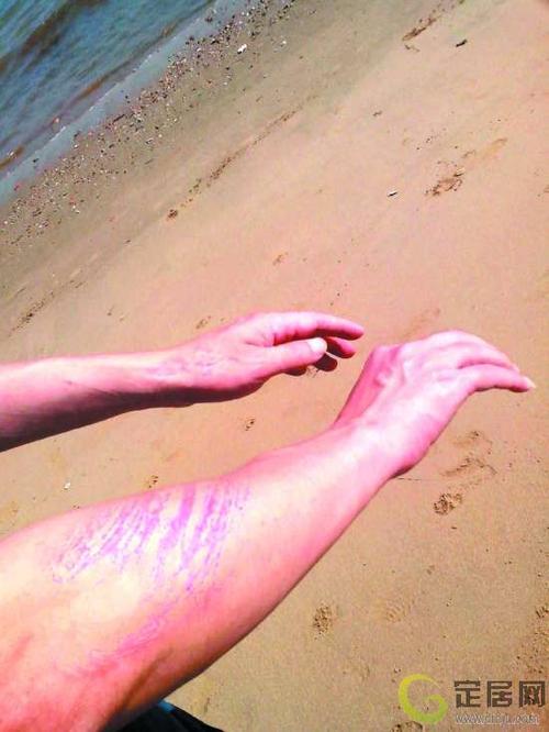 海滩游泳小心被水母蜇伤