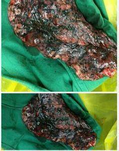 求一张吸烟人和没吸烟人的肺部图.越吓人越好.谢谢.