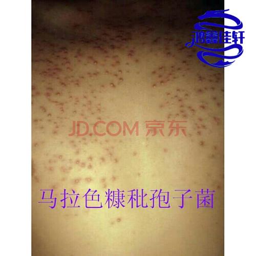 马拉色菌毛1囊炎身体头皮糠秕孢子菌性毛囊前胸后背部