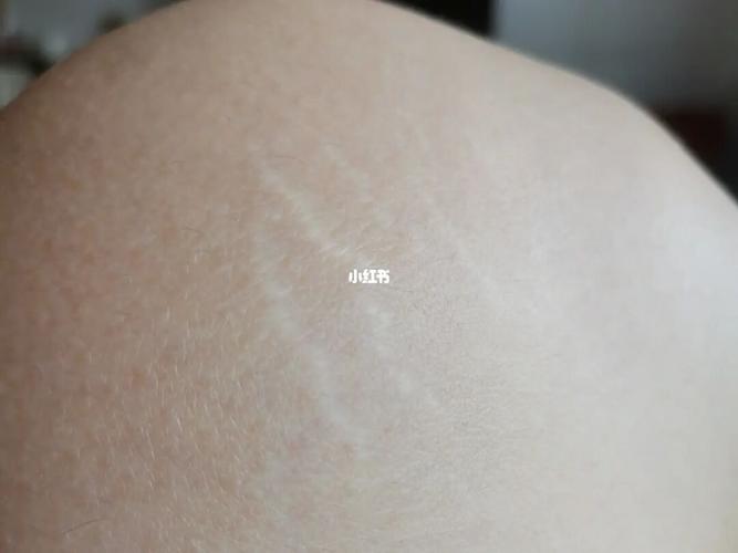 肥胖纹_肥胖纹_美妆_个人护理_身体护理