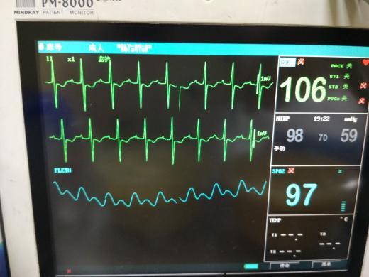 这个心电监护仪怎么看?各个数代表的什么意思?怎么样的才算正常.