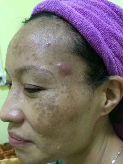 真皮斑形成的真正原因